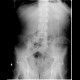 Percutaneous endoscopic gastrostomy, PEG: X-ray - Plain radiograph